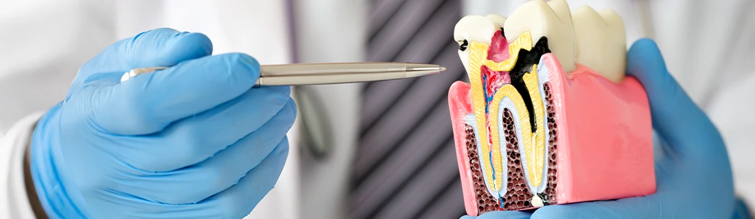 How Do You Know If You Need A Root Canal in Lewiston ME?