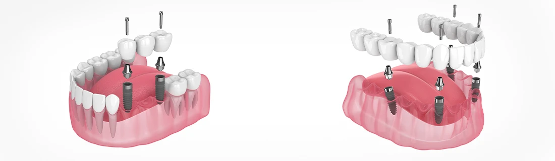 All-On-4® Dental Implants In Lewiston ME