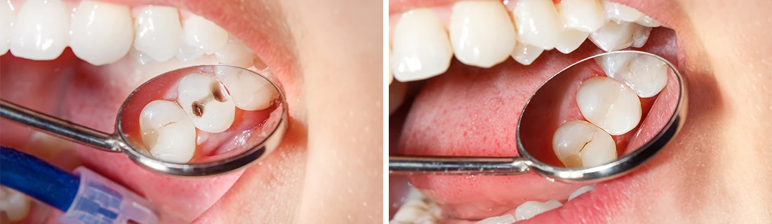 Dental Fillings in Lewiston ME