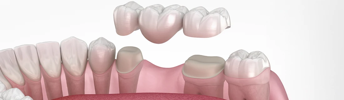 Dental Implants And Dental Bridges In Lewiston ME