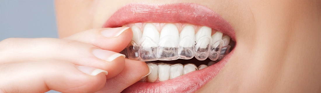 SureSmile Clear Aligners In Lewiston ME